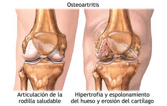 Comparación entre articulación de rodilla saludable y con osteoartritis — Artralon apoya la reconstrucción natural con alimentos reales